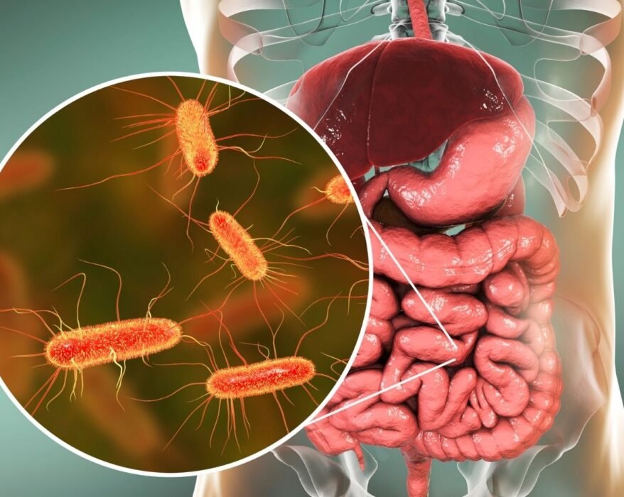 Colorectal cancer is on the rise especially in young adults under 54